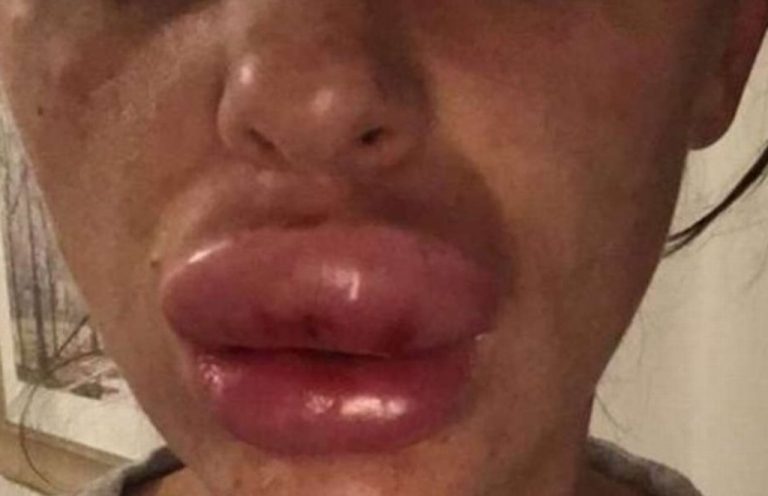 Acude a “Fiesta de botox” y termina con labios deformes