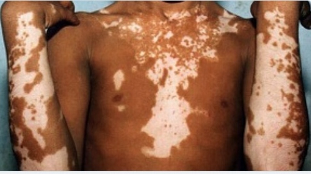 ¿Sabes qué es y cómo se produce el vitiligo? Aquí te decimos