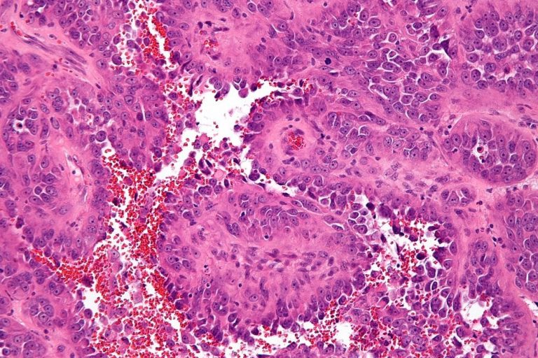 Estudio con pacientes de angiosarcoma revela posibles nuevas terapias