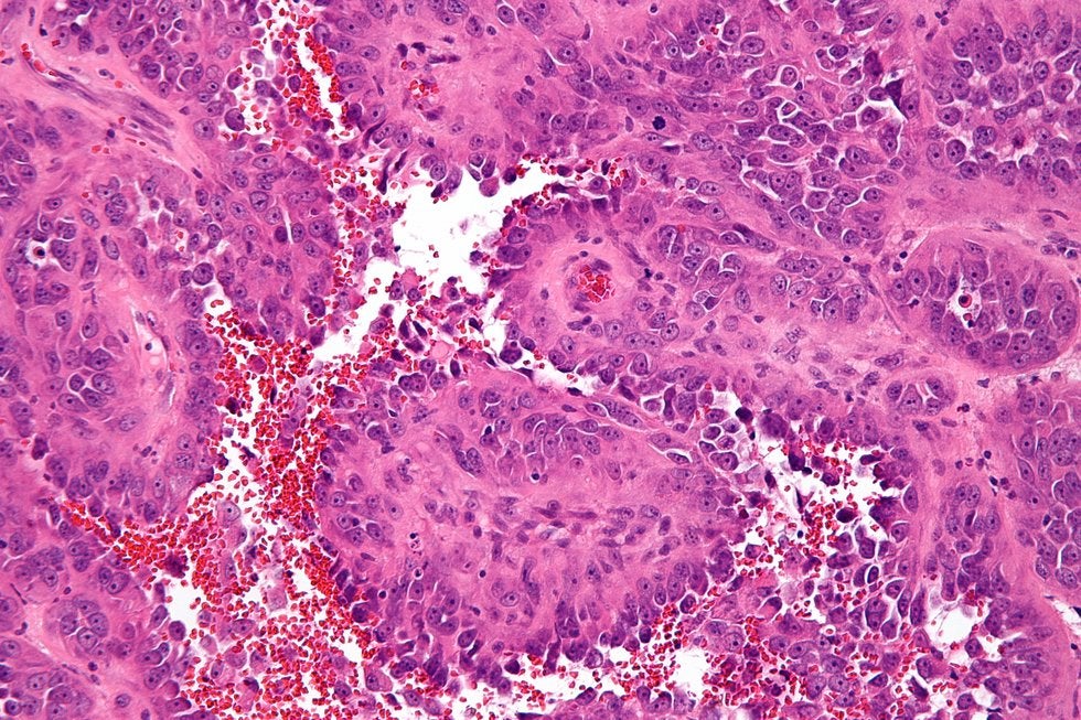 Estudio con pacientes de angiosarcoma revela posibles nuevas terapias